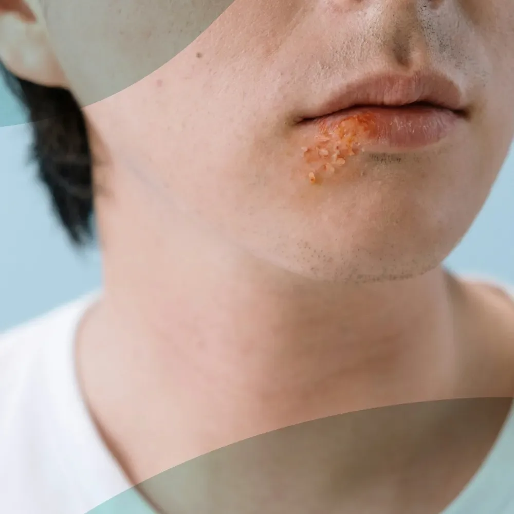 Close-up of a cold sore on a man's lip caused by herpes simplex virus type 1, the most visible sign of oral herpes tested at home in Dubai by Vesta Care